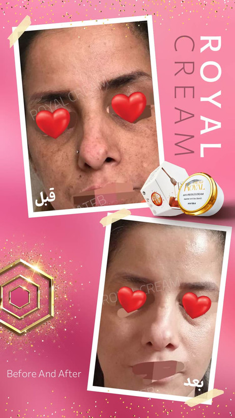 تست عملکرد کرم ضدلک ژل رویال - قبل و بعد